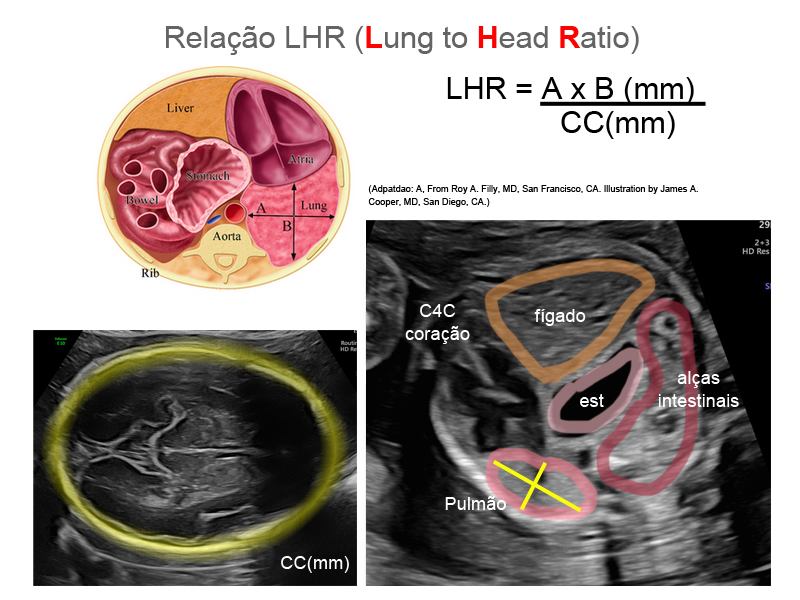 Hernia ultrasom