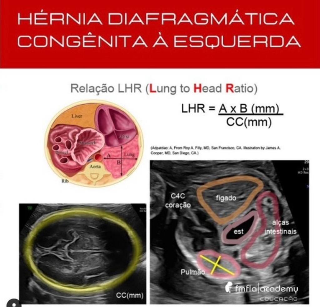 Hérnia Diafragmática Congênita: Como Ocorre o Diagnóstico ?