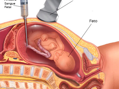 Anemia fetal