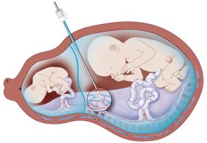 feto fetal 2