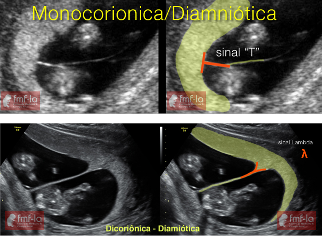 feto fetal 3